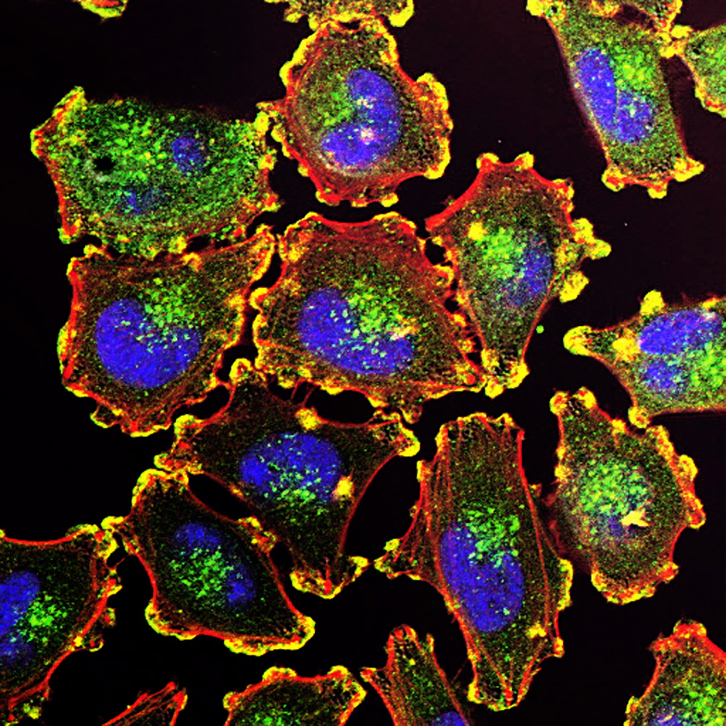 Metastatic Melanoma Cancer Cells. 