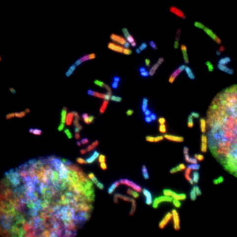 Brightly coloured chromosomes from brain cancer cells.